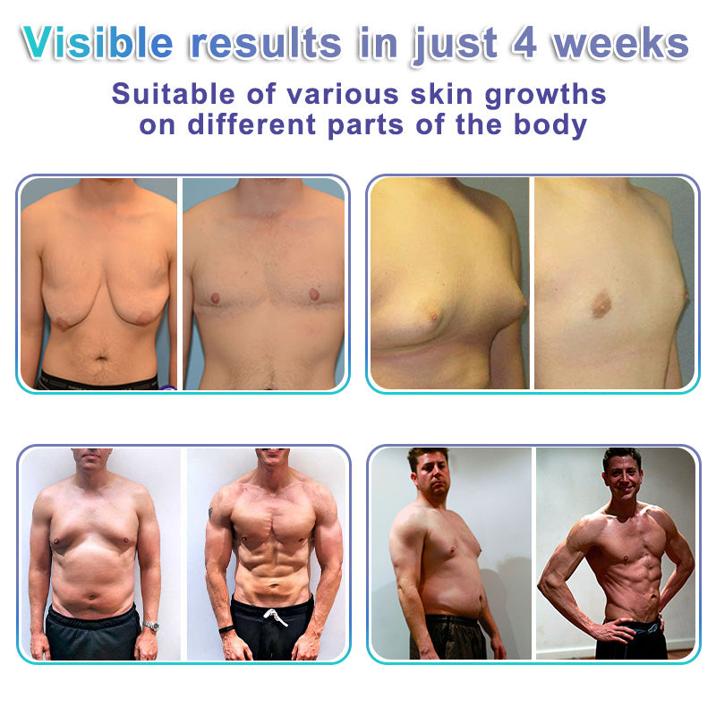 ⚕️GFOUK® NanoMedix Gynecomastia Chest Fatburn & Firm Patch